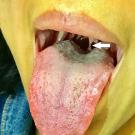 Uvula Abnormality