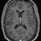 Cannabis-Induced Psychosis