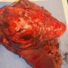 Prophylactic Cholecystectomy for Porcelain Gallbladder