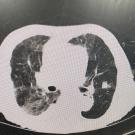 sphingobacterium case