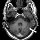 Wilson Disease