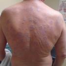 Amlodipine-Induced Eczematous Drug Eruption