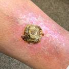 Necrobiosis lipoidica