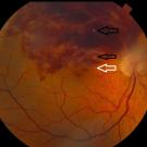 Branch Retinal Vein Occlusion