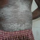 Myocardial Infarction Associated With Psoriasis