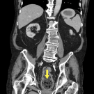 Infective Endocarditis Secondary to Granulicatella adiacens