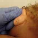 Ear Indentations on an Infant