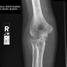 articular tuberculosis