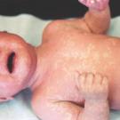 ROSEOLA INFANTUM