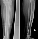 Idiopathic Intramedullary Osteosclerosis
