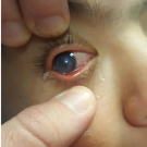 keratoconus