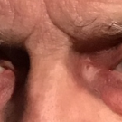 Sphenoid Sinus Mucocele