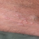 white papules
