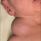 Cystic hygroma