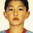 A Child With a Red Rash