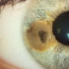 uveal melanoma