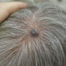 smooth, uniformly bluish-black papules