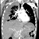 Pediatric Hemothorax
