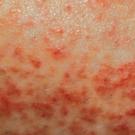 Atopic Dermatitis