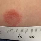 Photograph depicting the initial presentation of the patient’s lesion, a round patch with central clearing.