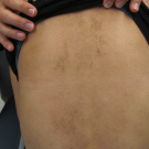 brown plaques on a young girl's back