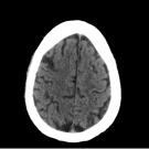 Non–contrast-enhanced CT of the head.