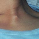 Branchial Cleft Anomalies