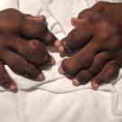 Bilateral Nodules of the Hands and Feet