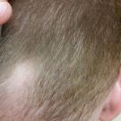 hair loss alopecia