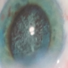 Eye