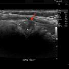 A 3.1-cm, ill-defined, heterogeneous, isoechoic solid nodule (arrow) with irregular margins, microcalcifications, and a taller-than-wide shape in the right lobe of the thyroid.