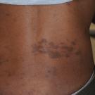 Syphilitic Meningitis