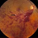 retinal vein occlusion