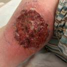 Pyoderma Gangrenosum