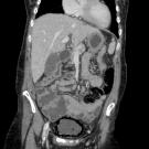 CT of the abdomen and pelvis