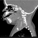 Figure 1_CT neck with Contrast in Sagittal View