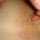 Acupuncture