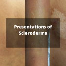 Scleroderma