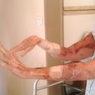 Photo shows the patient demonstrating right wrist weakness when asked to extend both hands.