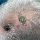 An ovoid plaque with pustular exudate and golden-brown crust is seen on the patient’s vertex scalp.