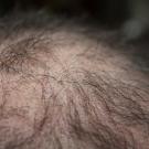 Hair Loss
