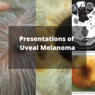 uveal melanoma 