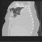 post-traumatic abnormal breathing scan