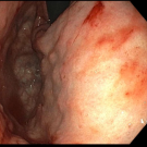 hereditary hemorrhagic telangiectasia figure 1