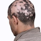 alopecia
