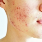 acne