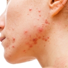 woman with acne