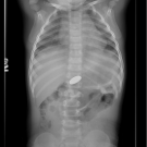 button battery xray
