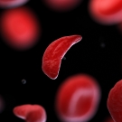 sickle cell disease 