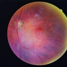 diabetic retinopathy